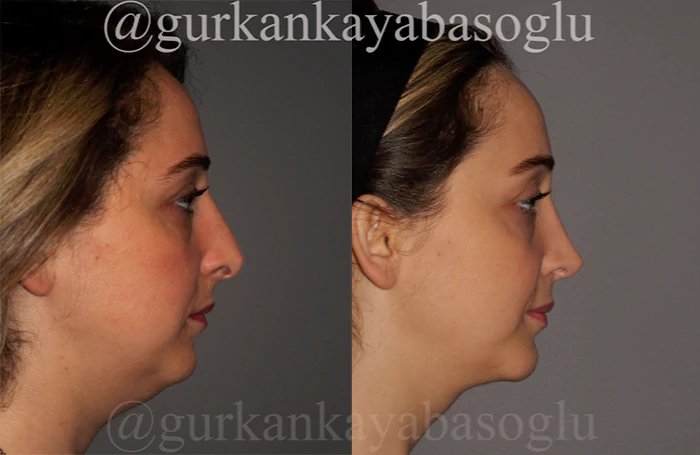 before & after photo of عملية تجميل الأنف