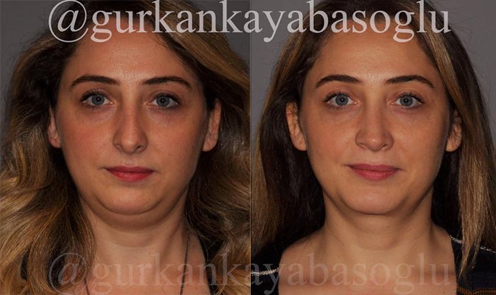 before & after photo of Chin Implants