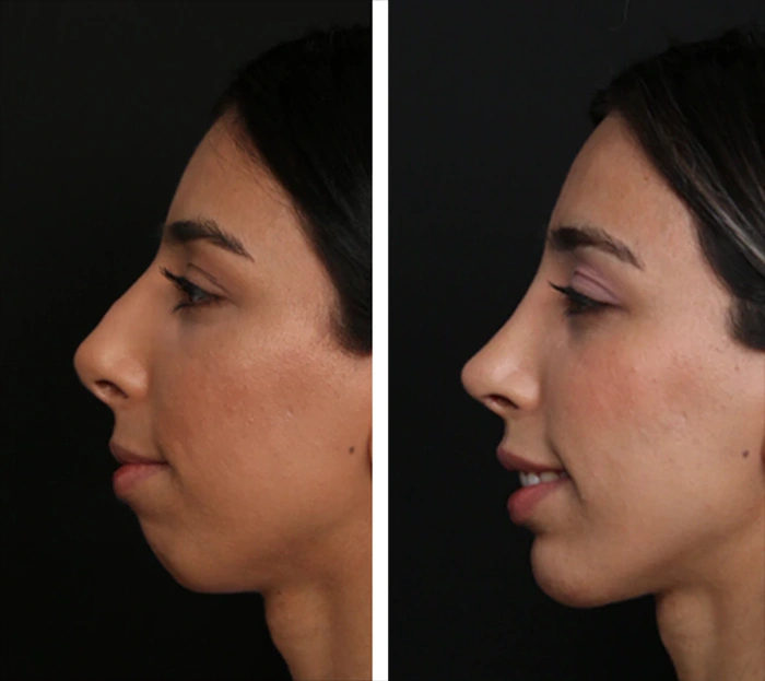 before & after photo of Rhinoplasty