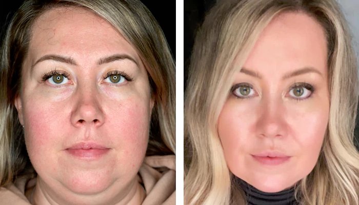 before & after photo of Double Chin Removal