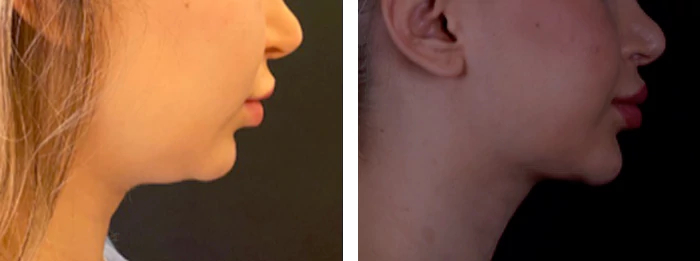 before & after photo of Double Chin Removal