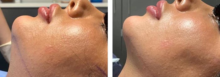 before & after photo of Double Chin Removal