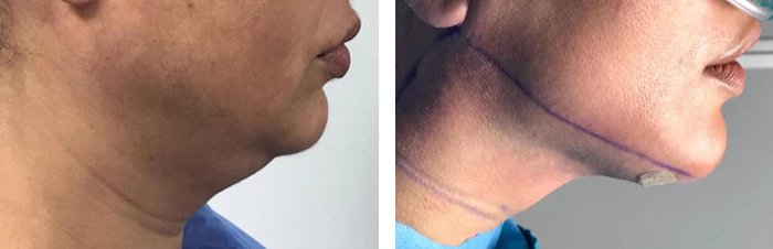 before & after photo of Double Chin Removal