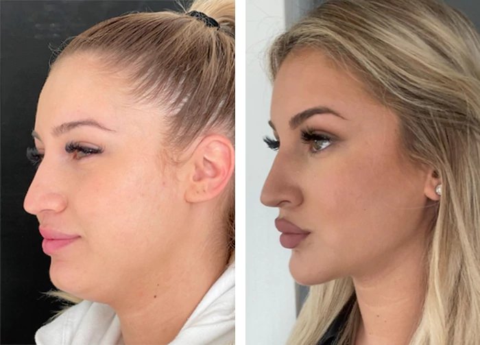 before & after photo of Double Chin Removal