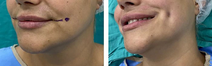 before & after photo of Dimple Surgery