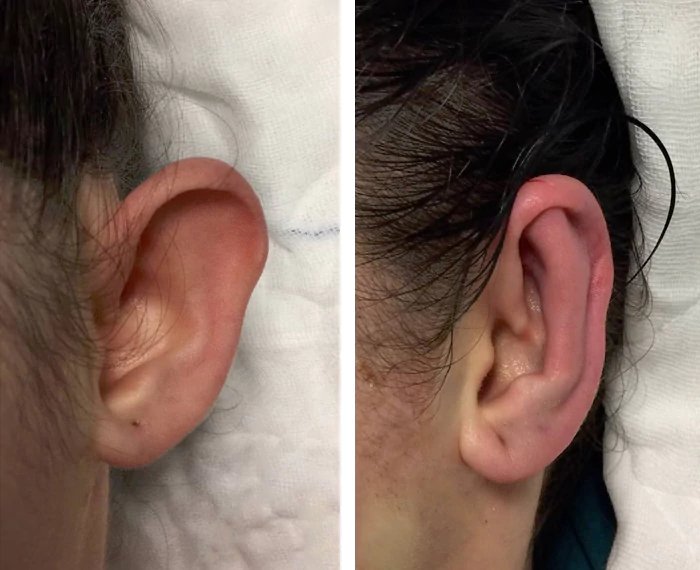 before & after photo of Ear Reconstruction Surgery