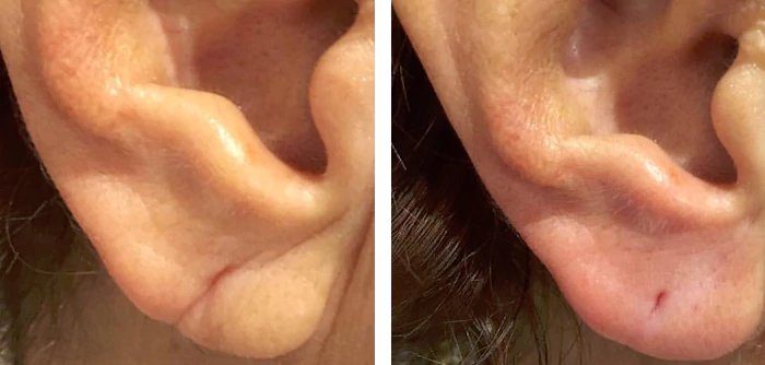 before & after photo of earlobe-surgery