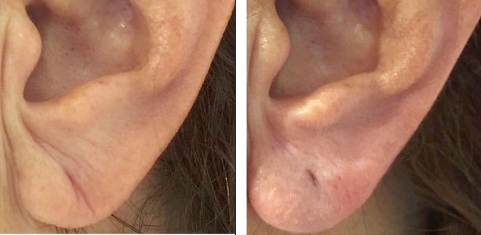 before & after photo of Earlobe Surgery