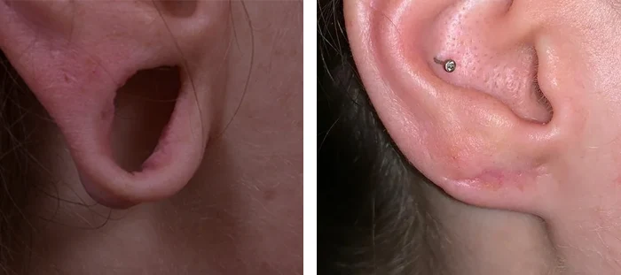 before & after photo of Earlobe Surgery