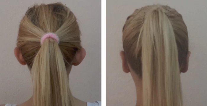 before & after photo of عملية تجميل الأذن