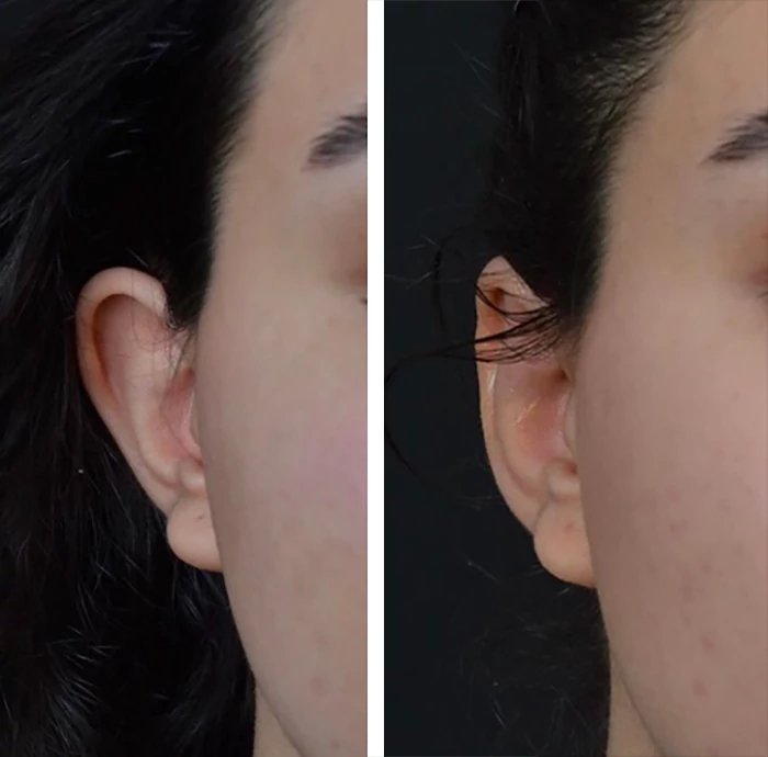 before & after photo of Rhinoplasty