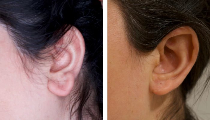 before & after photo of earlobe-surgery
