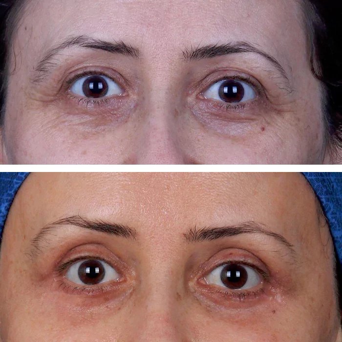 before & after photo of عملية تجميل الجفون