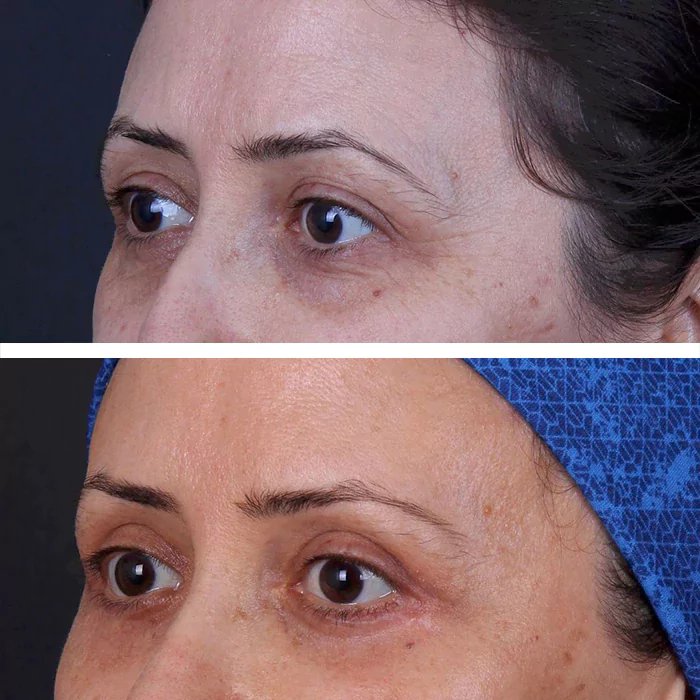 before & after photo of Rhinoplasty