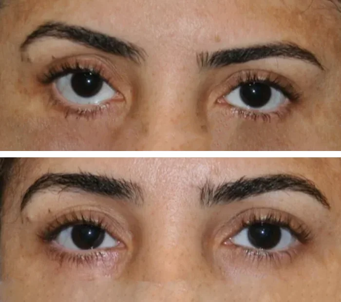 before & after photo of عملية تجميل الجفون