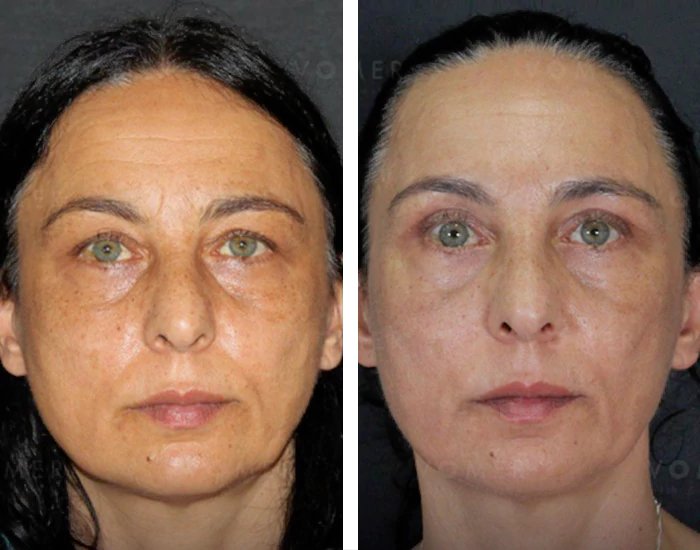 before & after photo of عملية تجميل الجفون