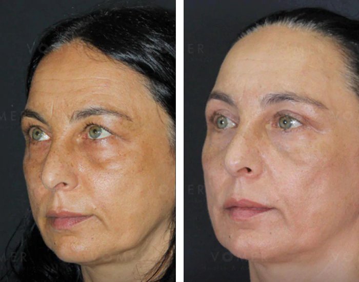 before & after photo of عملية تجميل الجفون