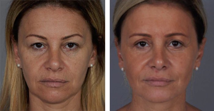 before & after photo of عملية تجميل الجفون