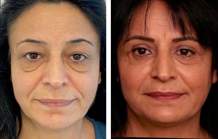 before & after photo of عملية تجميل الجفون