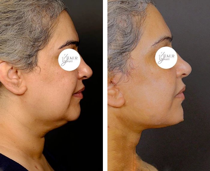 before & after photo of neck-lift