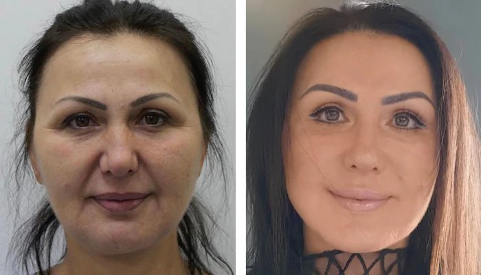 before & after photo of عملية تجميل الأنف