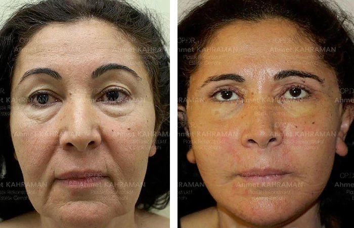 before & after photo of عملية تجميل الأنف