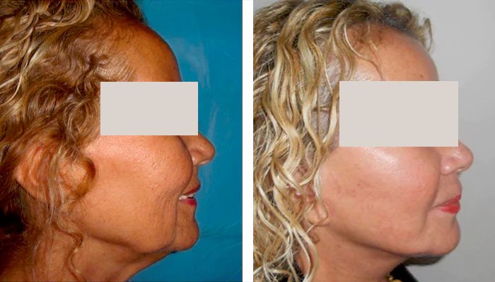 before & after photo of Liposuction