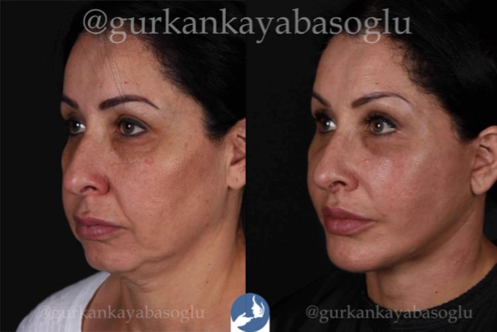 before & after photo of عملية تجميل الأنف