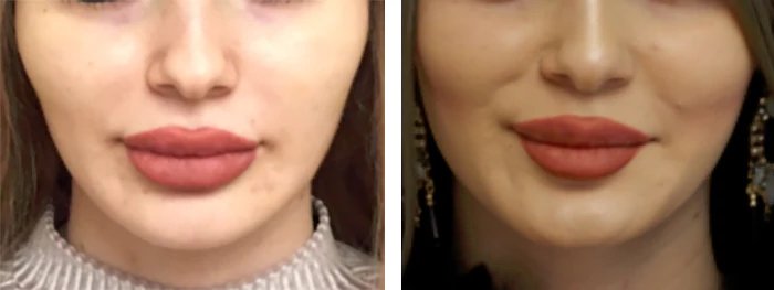 before & after photo of Facial Fat Transfer