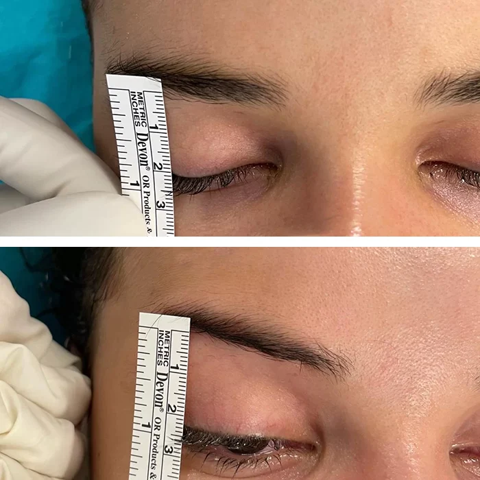 before & after photo of Cat Eye Surgery