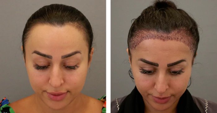 before & after photo of hairline-lowering-hair-transplant