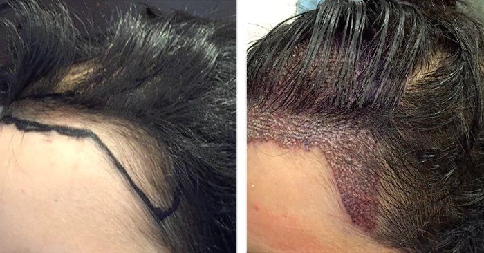 before & after photo of Hairline Lowering (Hair Transplant)
