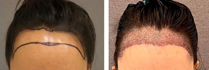 before & after photo of hairline-lowering-hair-transplant