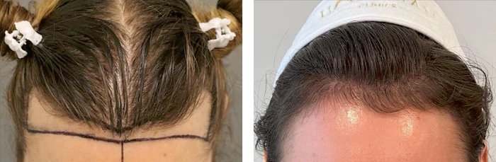 before & after photo of زراعة الشعر