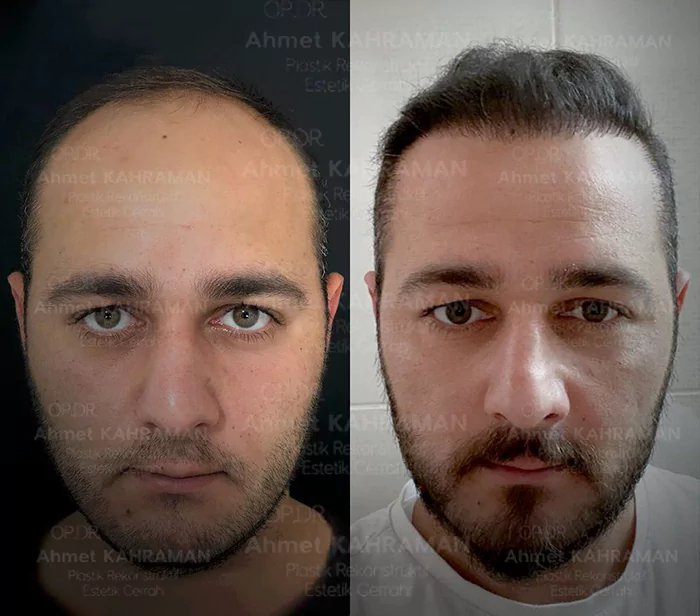 before & after photo of زراعة الشعر