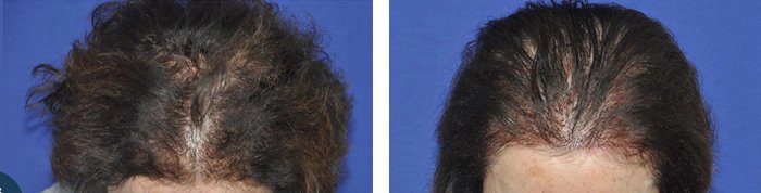 before & after photo of Hair Transplant