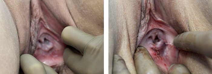 before & after photo of Labiaplasty