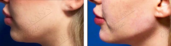 before & after photo of Chin and Jawline Filler