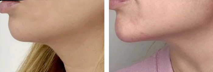 before & after photo of Chin and Jawline Filler