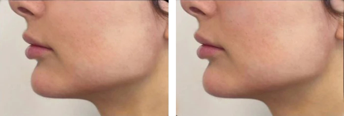 before & after photo of Chin and Jawline Filler