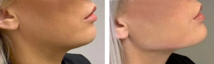 before & after photo of Chin and Jawline Filler