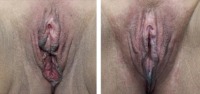 before & after photo of تجميل الشفرين