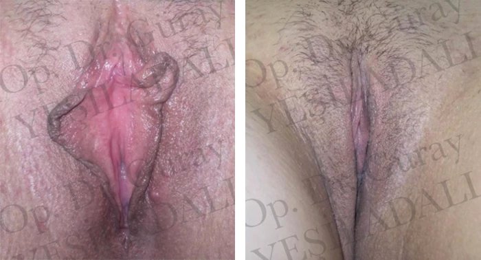 before & after photo of Labiaplasty