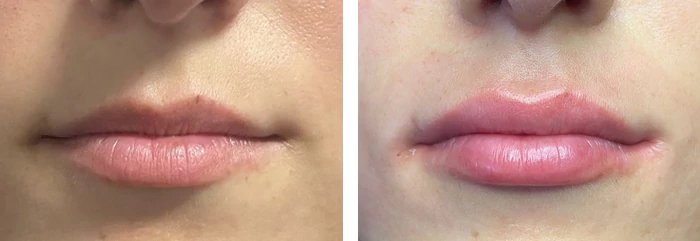 before & after photo of lip-augmentation