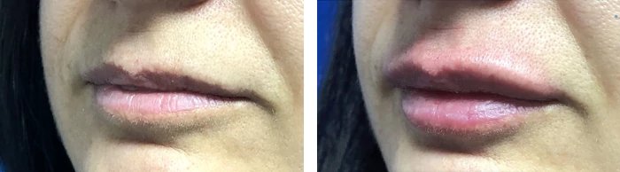 before & after photo of Lip Filler