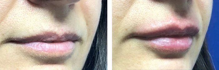 before & after photo of Lip Filler