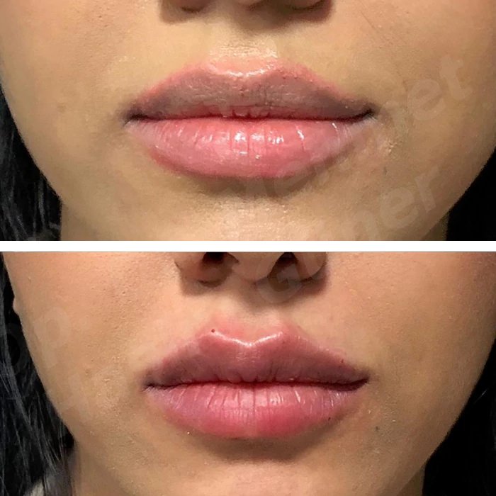 before & after photo of Lip Lift