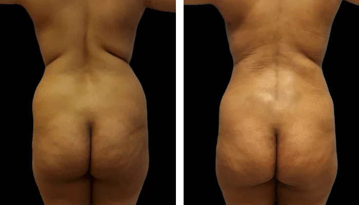 before & after photo of Tummy Tuck