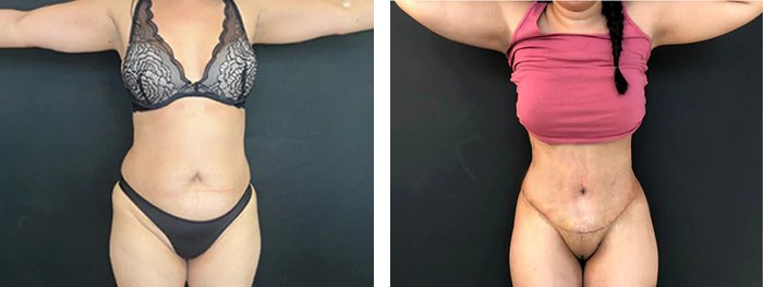 before & after photo of Tummy Tuck