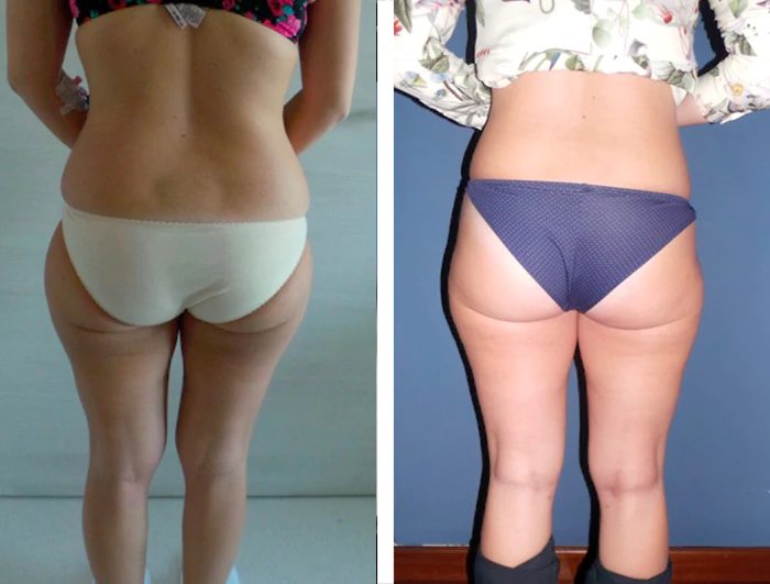 before & after photo of Liposuction